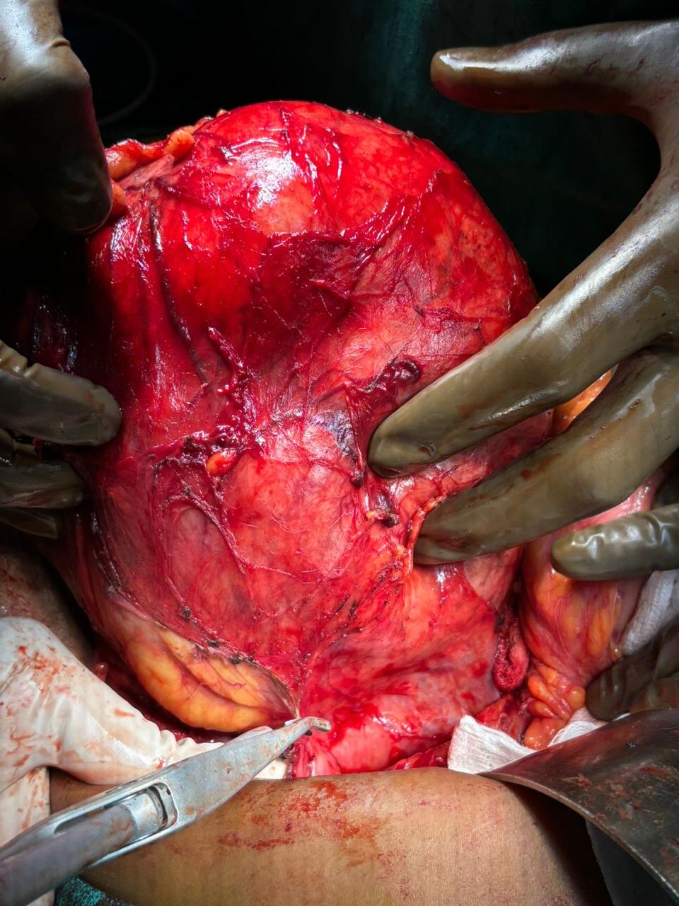 Dr. Nikhilesh Jibhakate Urologist In Nagpur - Jibhakate Urocare Centre - Andrologist, and Renal Transplant Surgeon Nagpur MH 5