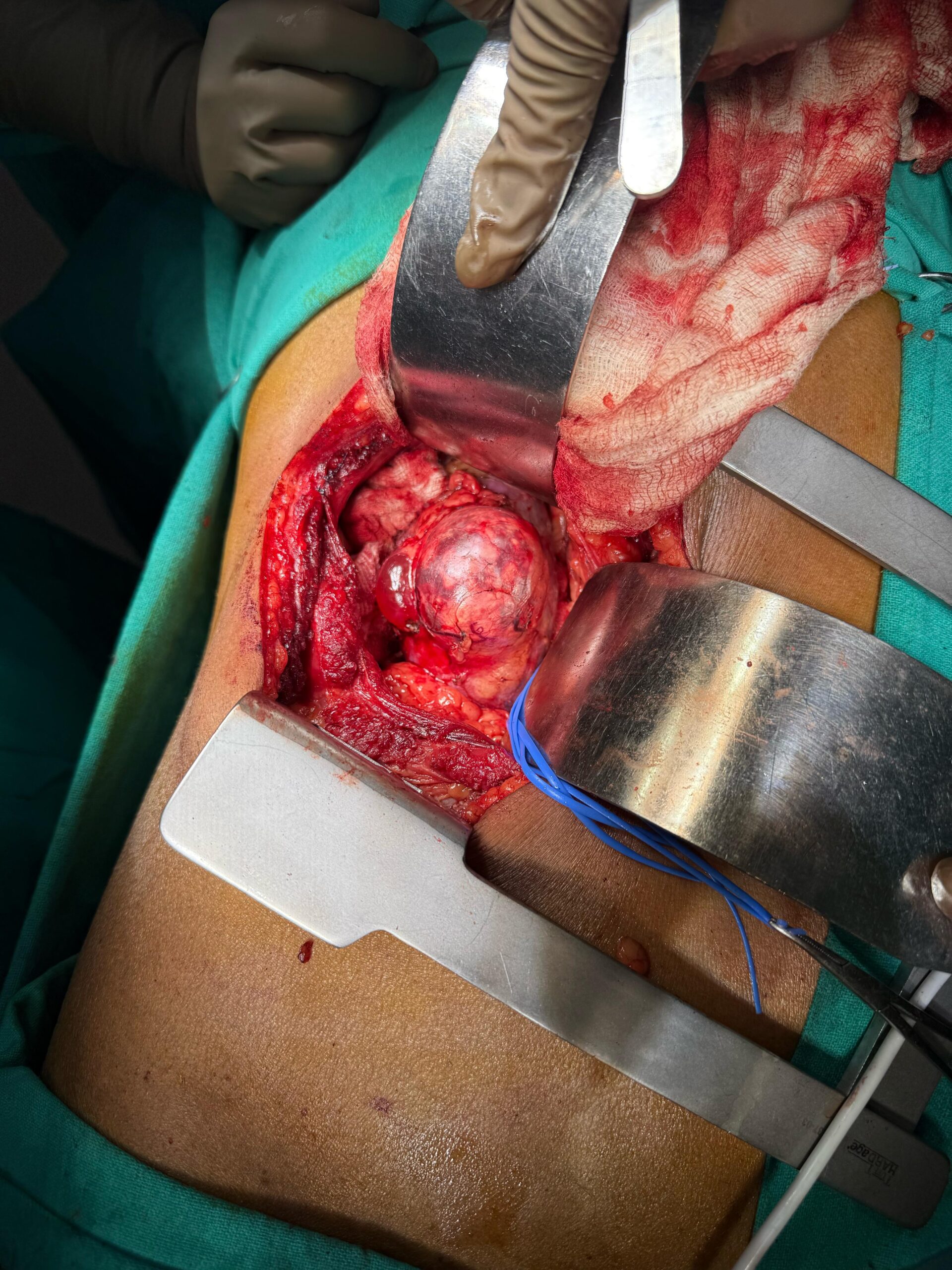 Dr. Nikhilesh Jibhakate Urologist In Nagpur Jibhakate Urocare Centre Andrologist, and Renal Transplant Surgeon Partial Nephrectomy for kidney cancer 2