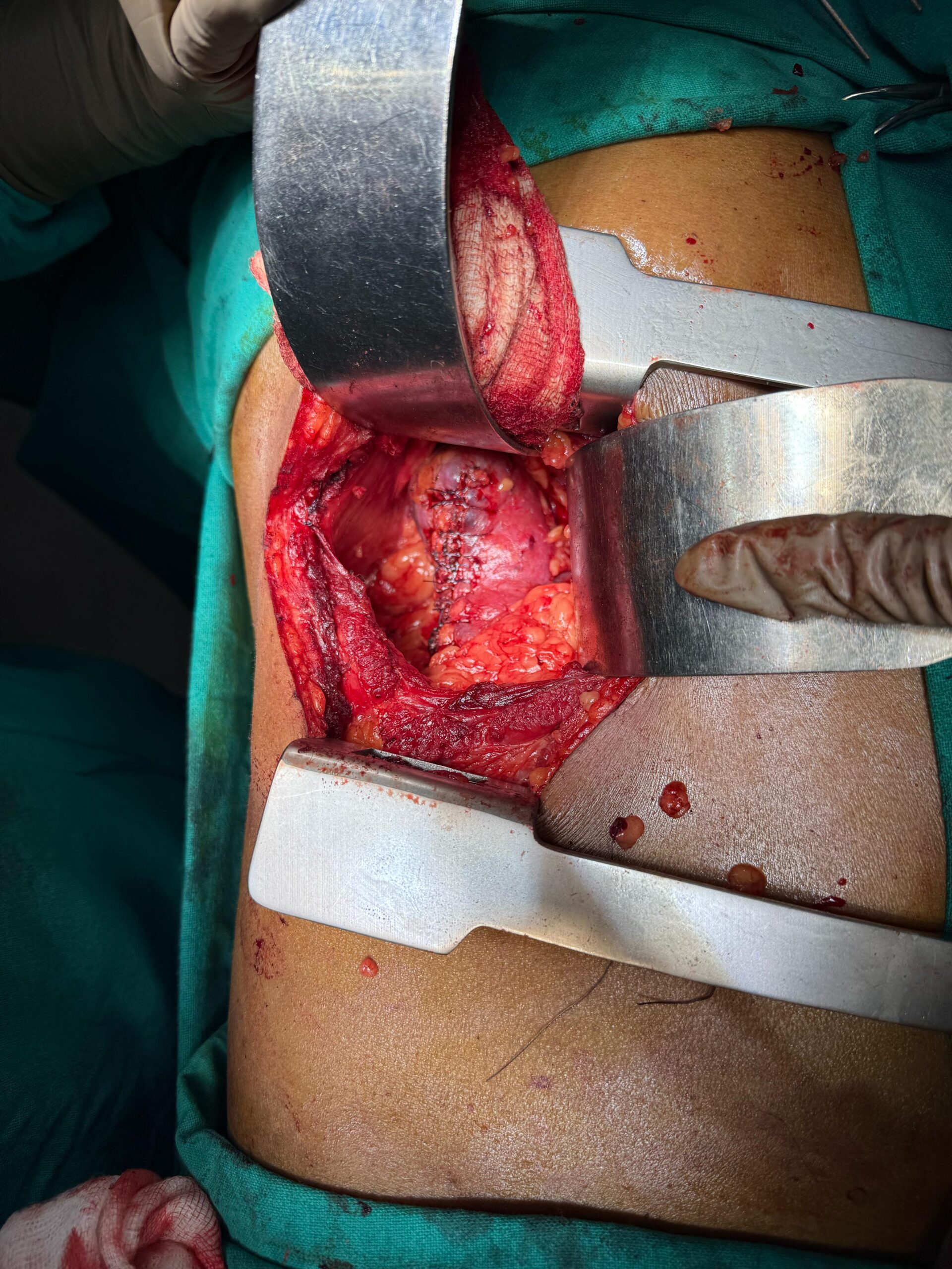 Dr. Nikhilesh Jibhakate Urologist In Nagpur Jibhakate Urocare Centre Andrologist, and Renal Transplant Surgeon Partial Nephrectomy for kidney cancer 3