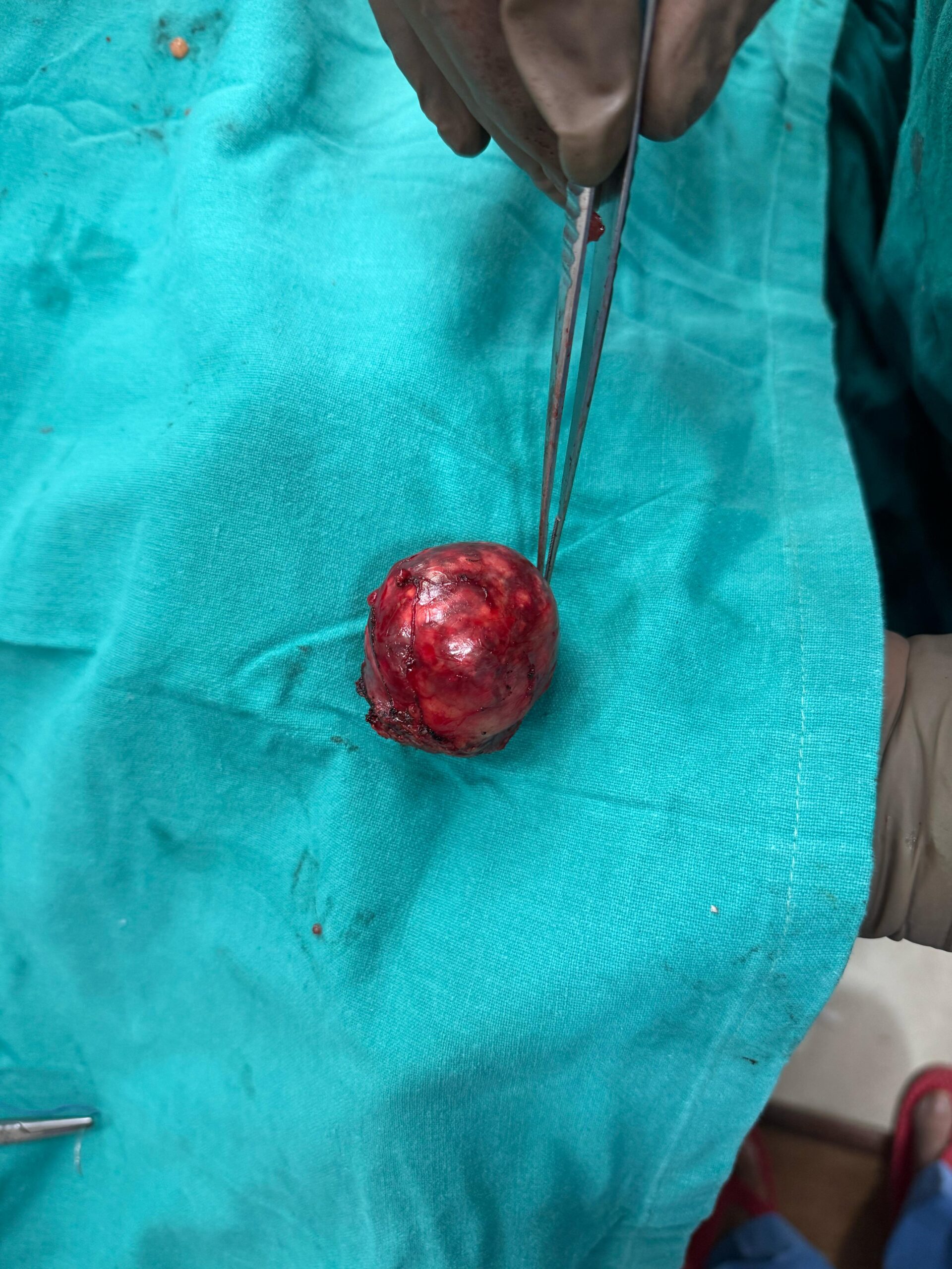 Dr. Nikhilesh Jibhakate Urologist In Nagpur Jibhakate Urocare Centre Andrologist, and Renal Transplant Surgeon Partial Nephrectomy for kidney cancer 4