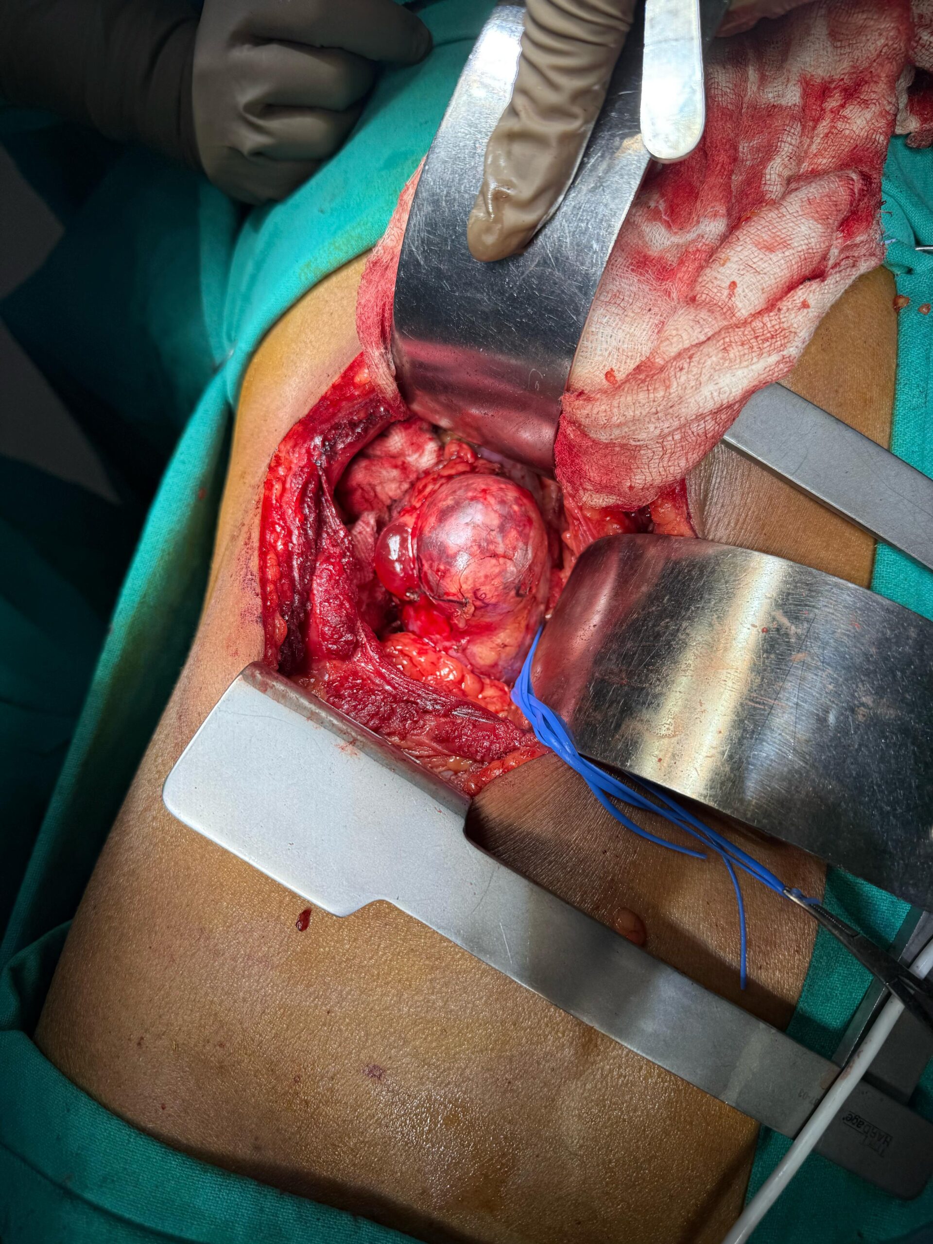 Dr. Nikhilesh Jibhakate Urologist In Nagpur Jibhakate Urocare Centre Andrologist, and Renal Transplant Surgeon Partial Nephrectomy for kidney cancer 5