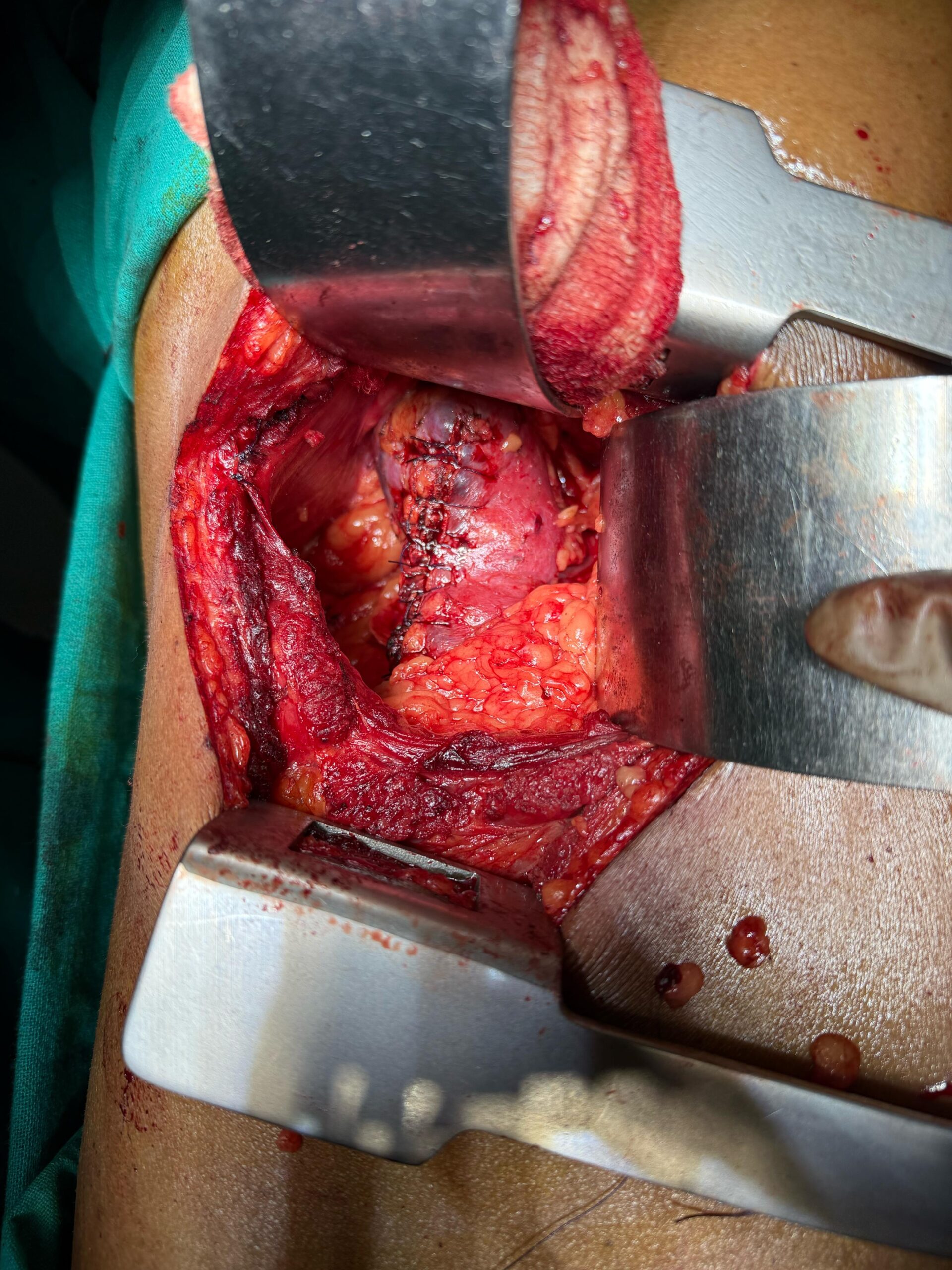 Dr. Nikhilesh Jibhakate Urologist In Nagpur Jibhakate Urocare Centre Andrologist, and Renal Transplant Surgeon Partial Nephrectomy for kidney cancer 6