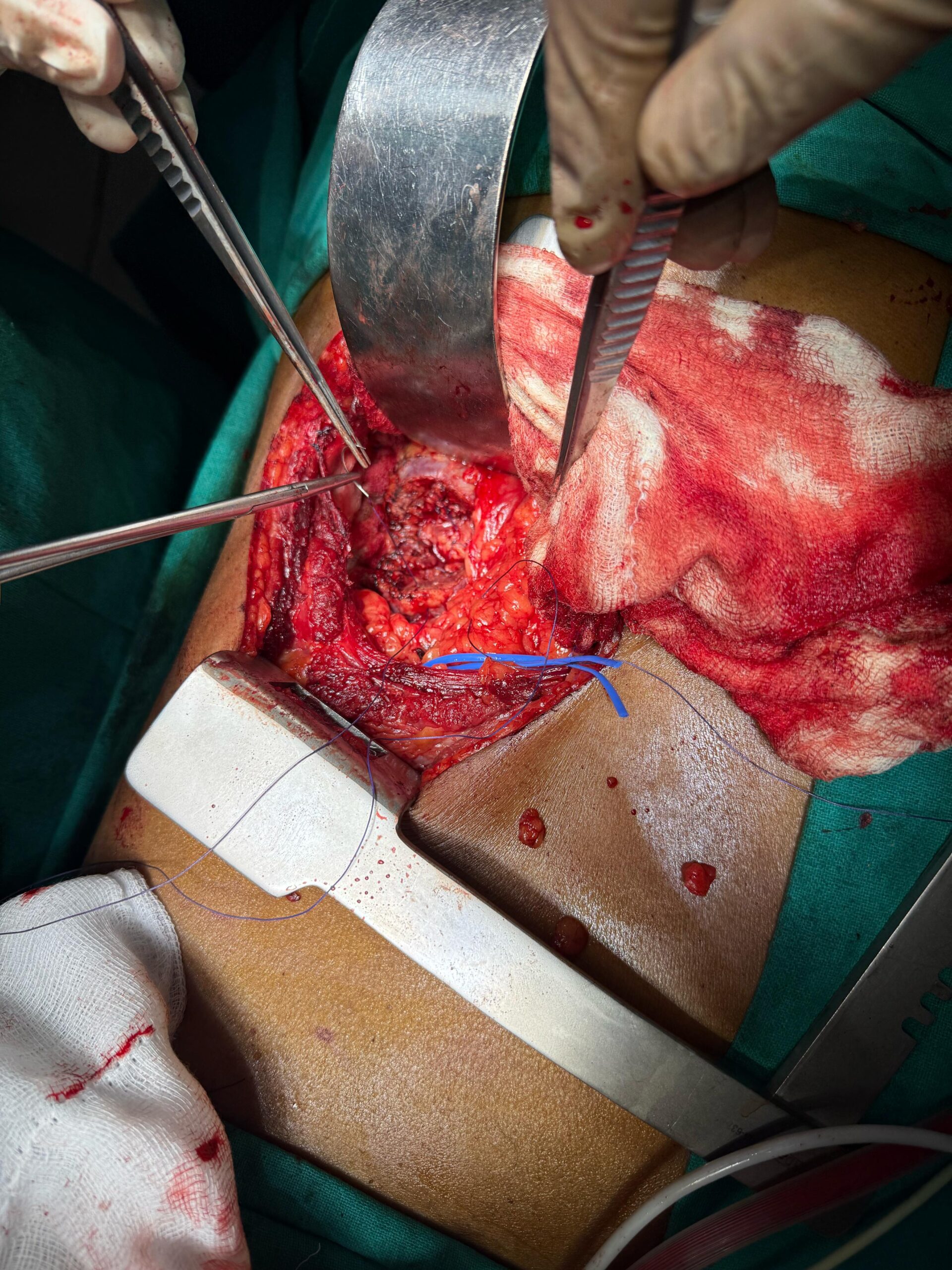 Dr. Nikhilesh Jibhakate Urologist In Nagpur Jibhakate Urocare Centre Andrologist, and Renal Transplant Surgeon Partial Nephrectomy for kidney cancer